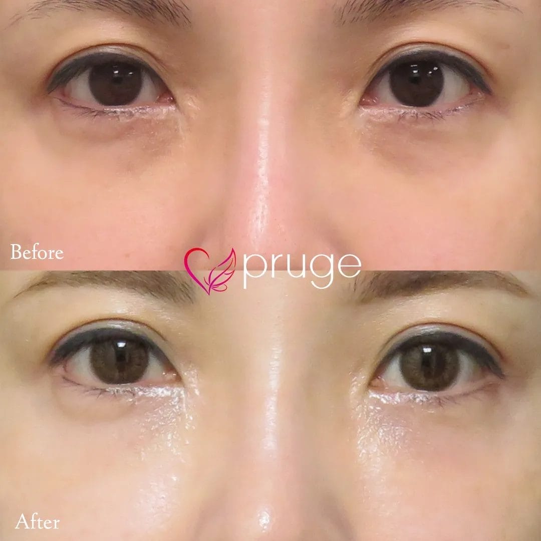 目の下のクマ・凹み