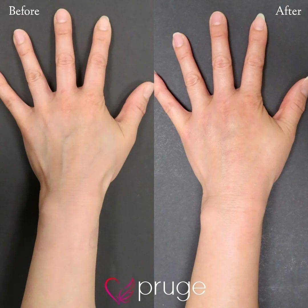 手の甲のスジ・乾燥