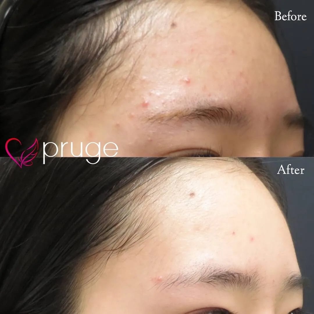 ヴァンパイアフェイシャル（全顔）