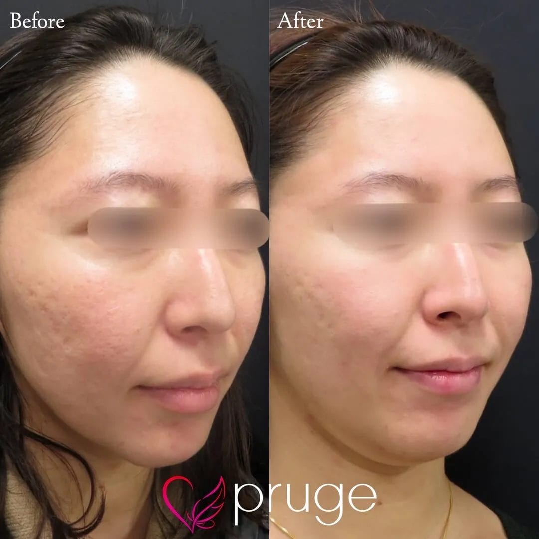 ヴァンパイアフェイシャル（全顔）