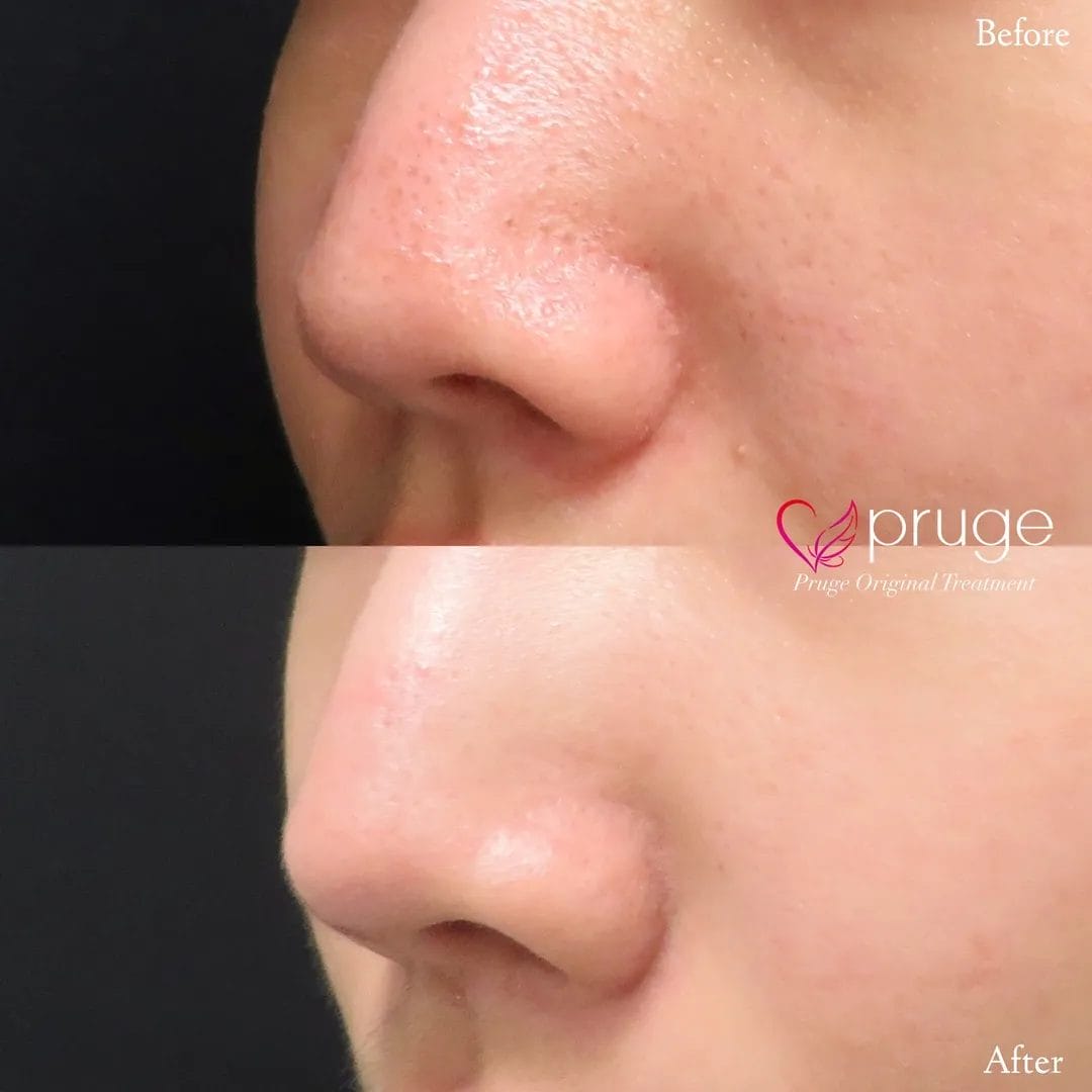 ヴァンパイアフェイシャル（鼻）