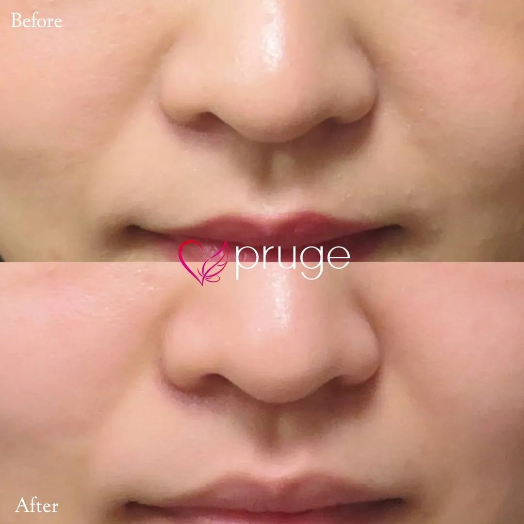 ご自身の血液から抽出したPRPを皮下組織に注入し、組織の修復効果が得られることで、症状が改善します。