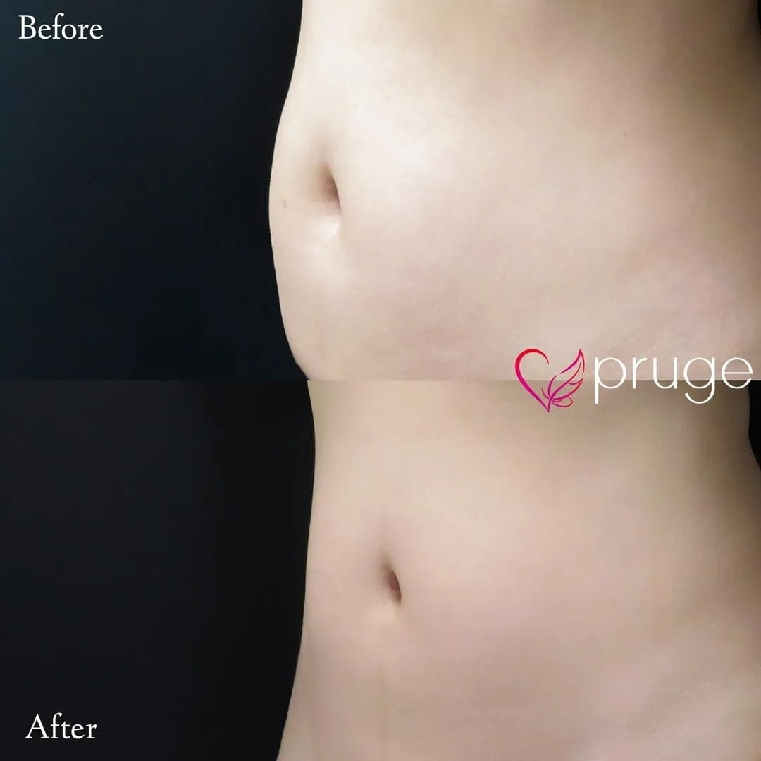 Pスリム注射（お腹）