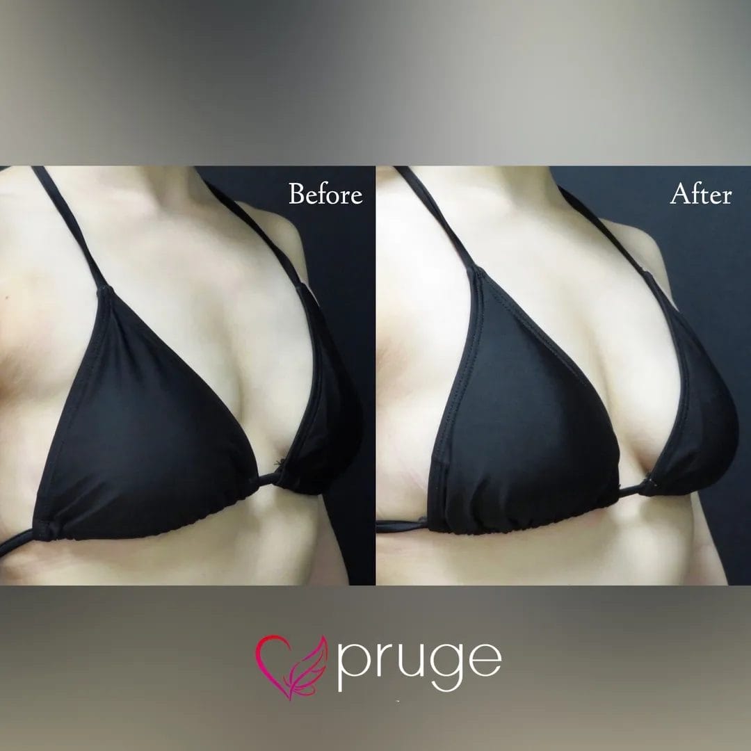 PRP注射（お胸）