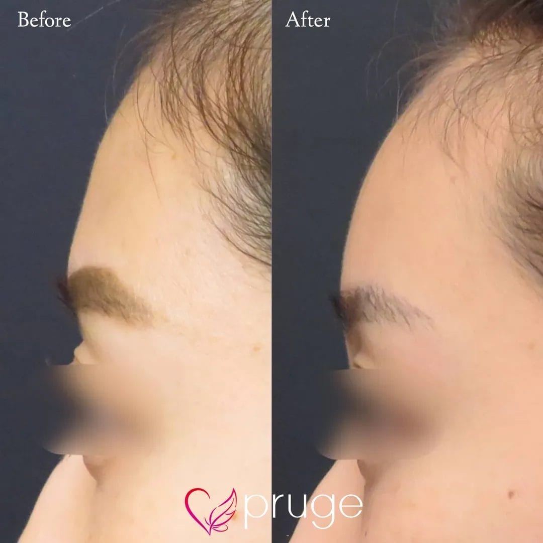 額の傾斜・こめかみの凹み