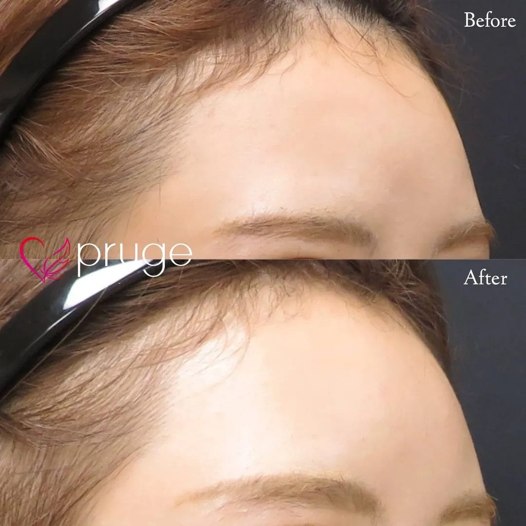 額・こめかみの凹み