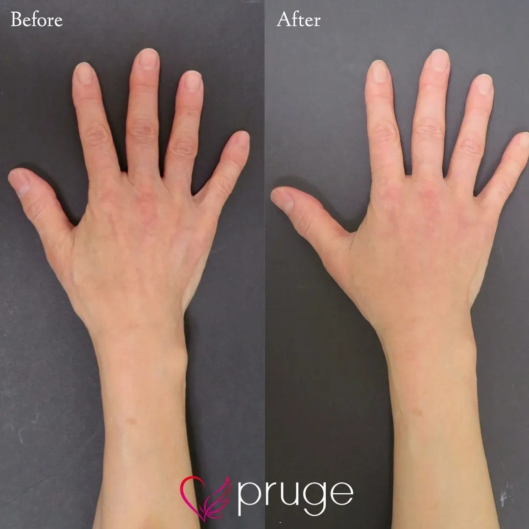 手の甲のスジ・乾燥