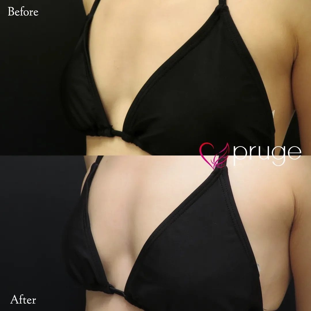 PRP注射（お胸）