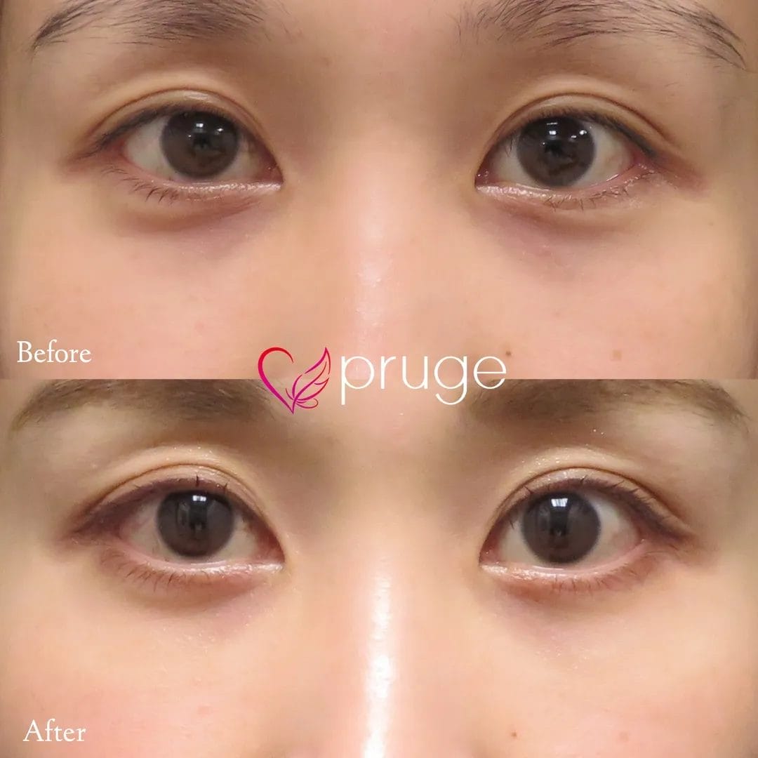 目の下のクマ・色素沈着