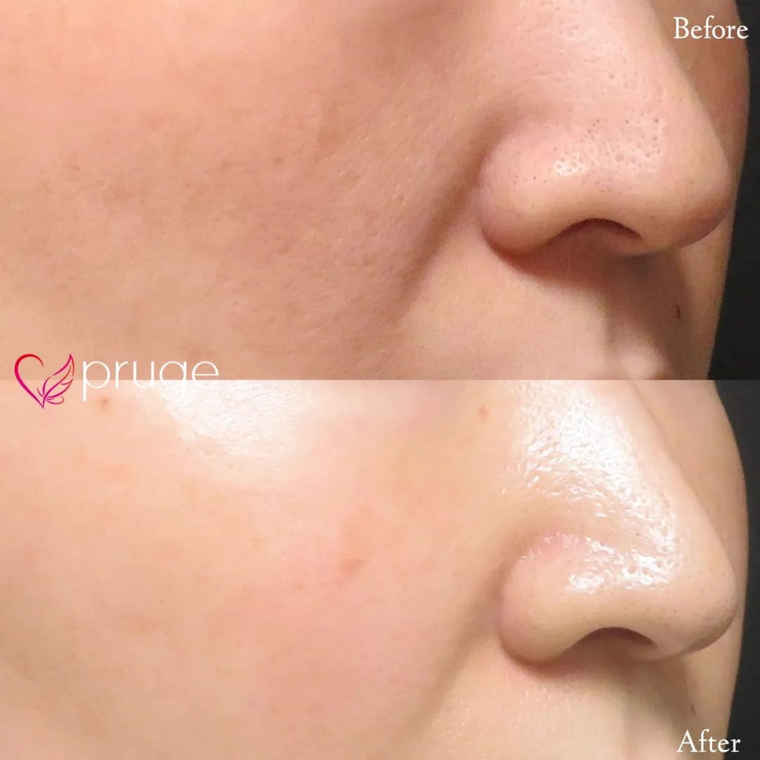 ヴァンパイアフェイシャル（全顔）