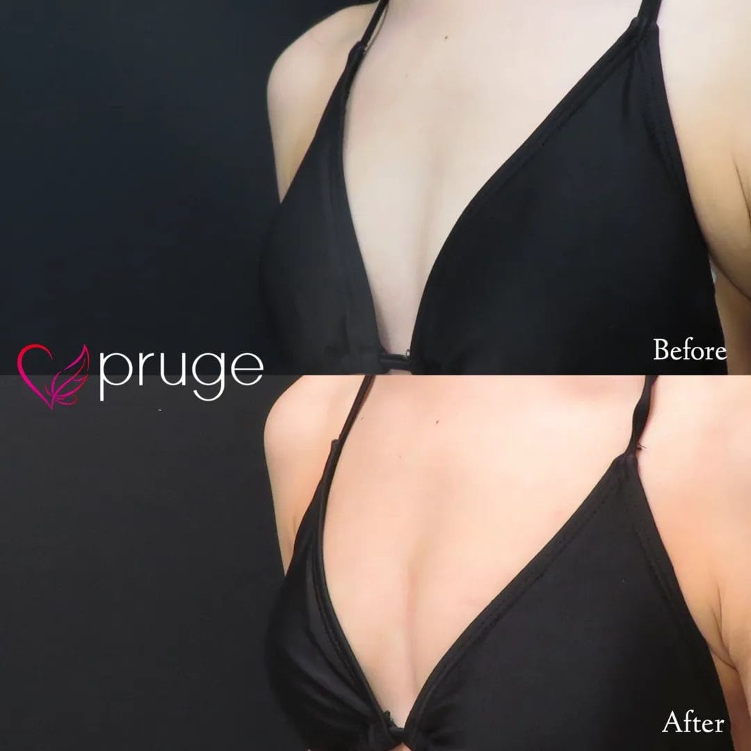 PRP注射（お胸）