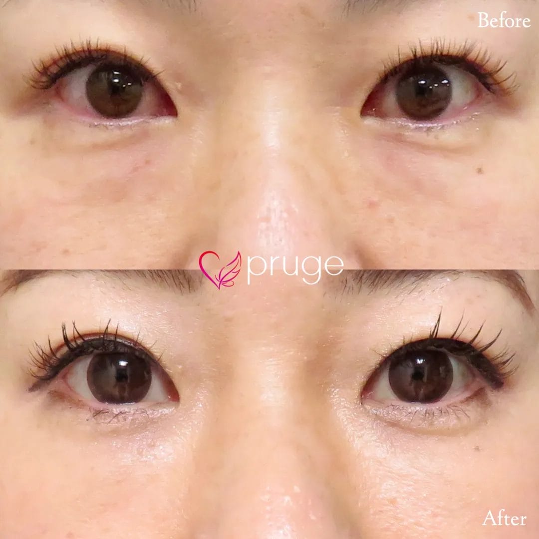 経結膜脱脂術で眼窩脂肪を取り除き、ご自身の血液から抽出したPRPを、皮下組織に注入し、組織の修復効果が得られることで、症状が改善します。