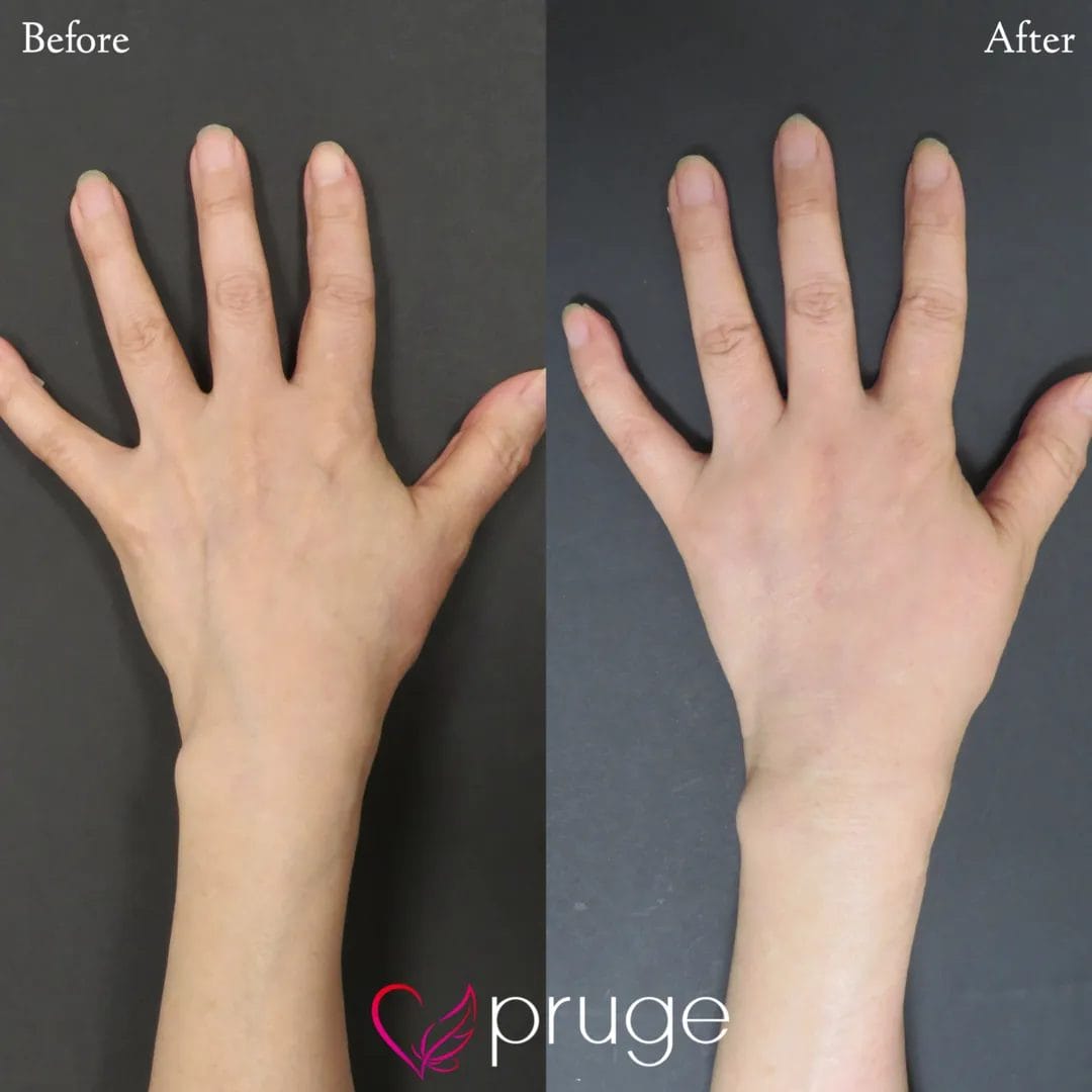 手の甲のスジ・乾燥