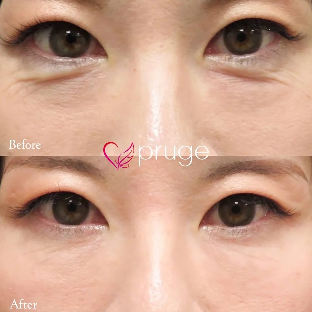 目の下のクマ・小じわ