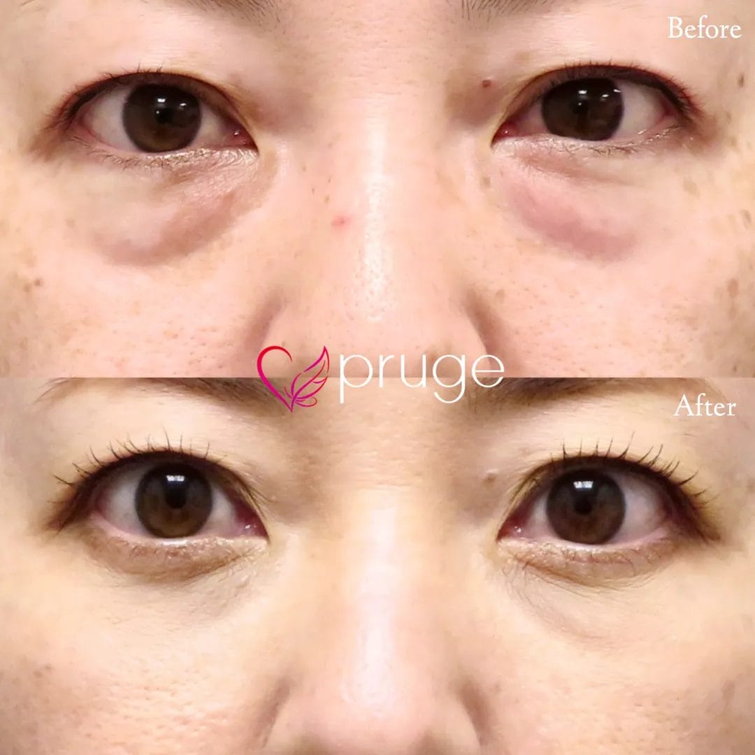 経結膜脱脂術で眼窩脂肪を取り除き、ご自身の血液から抽出したPRPを、皮下組織に注入し、組織の修復効果が得られることで、症状が改善します。