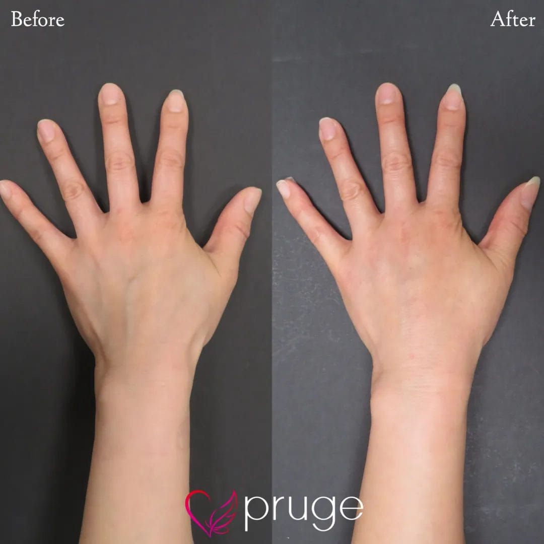 手の甲のスジ・血管