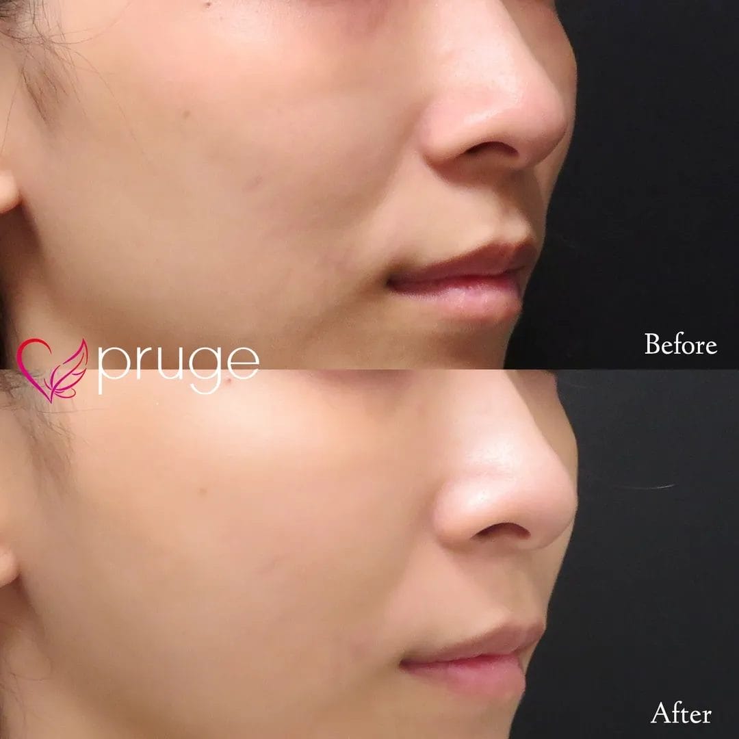 ご自身の血液から抽出したPRPを皮下組織に注入し、組織の修復効果が得られることで、症状が改善します。