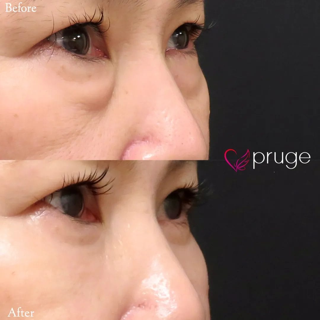 経結膜脱脂術で眼窩脂肪を取り除き、ご自身の血液から抽出したPRPを、皮下組織に注入し、組織の修復効果が得られることで、症状が改善します。