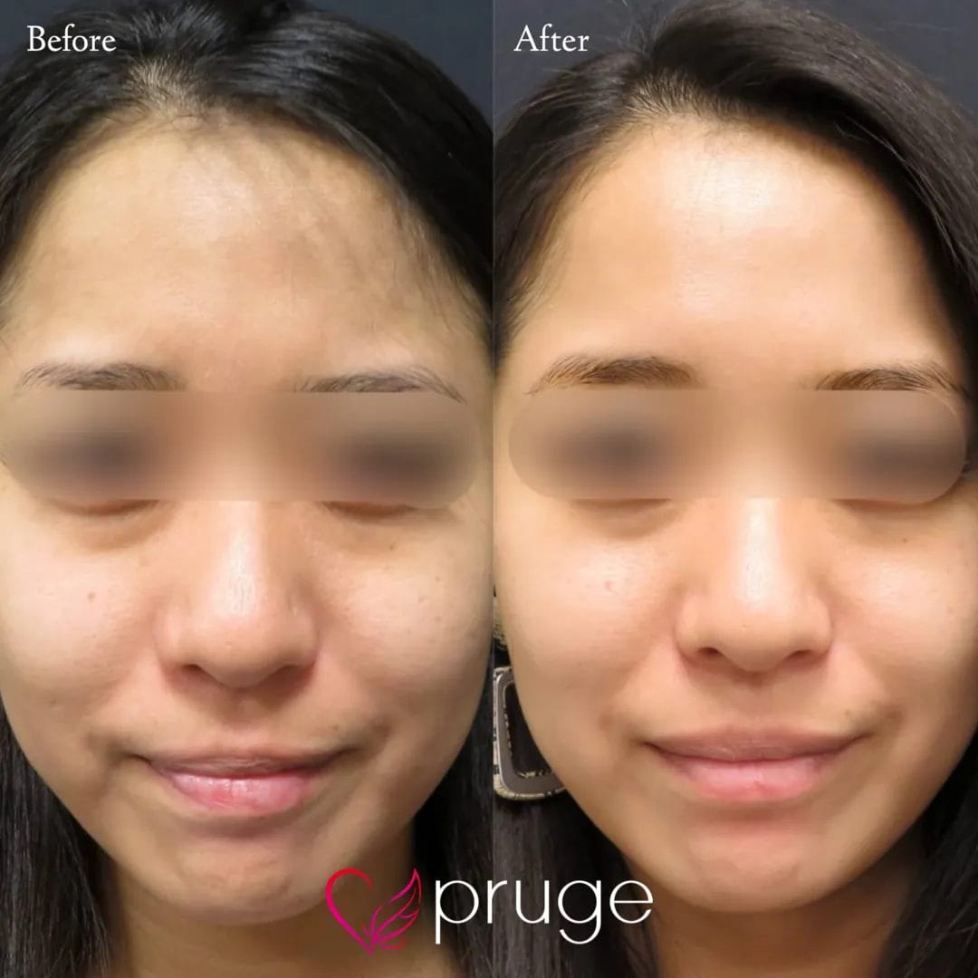 ヴァンパイアフェイシャル（全顔）