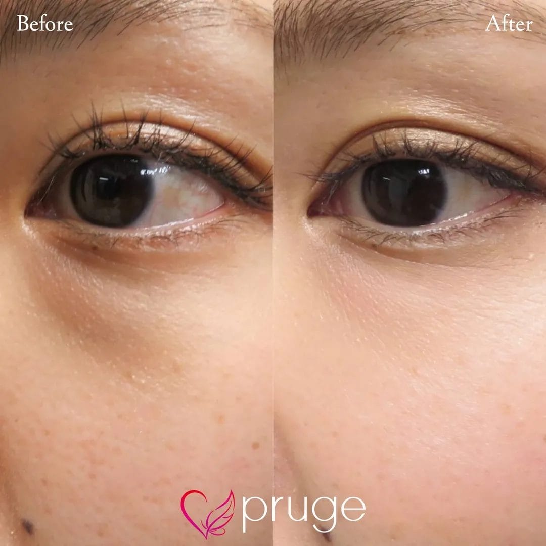 目の下のクマ・色素沈着