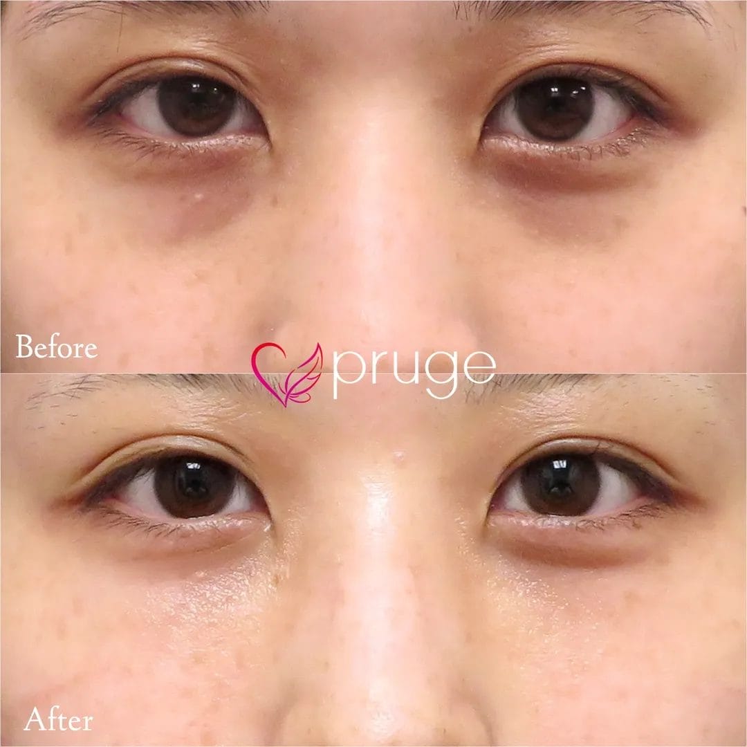 経結膜脱脂術で眼窩脂肪を取り除き、ご自身の血液から抽出したPRPを、皮下組織に注入し、組織の修復効果が得られることで、症状が改善します。