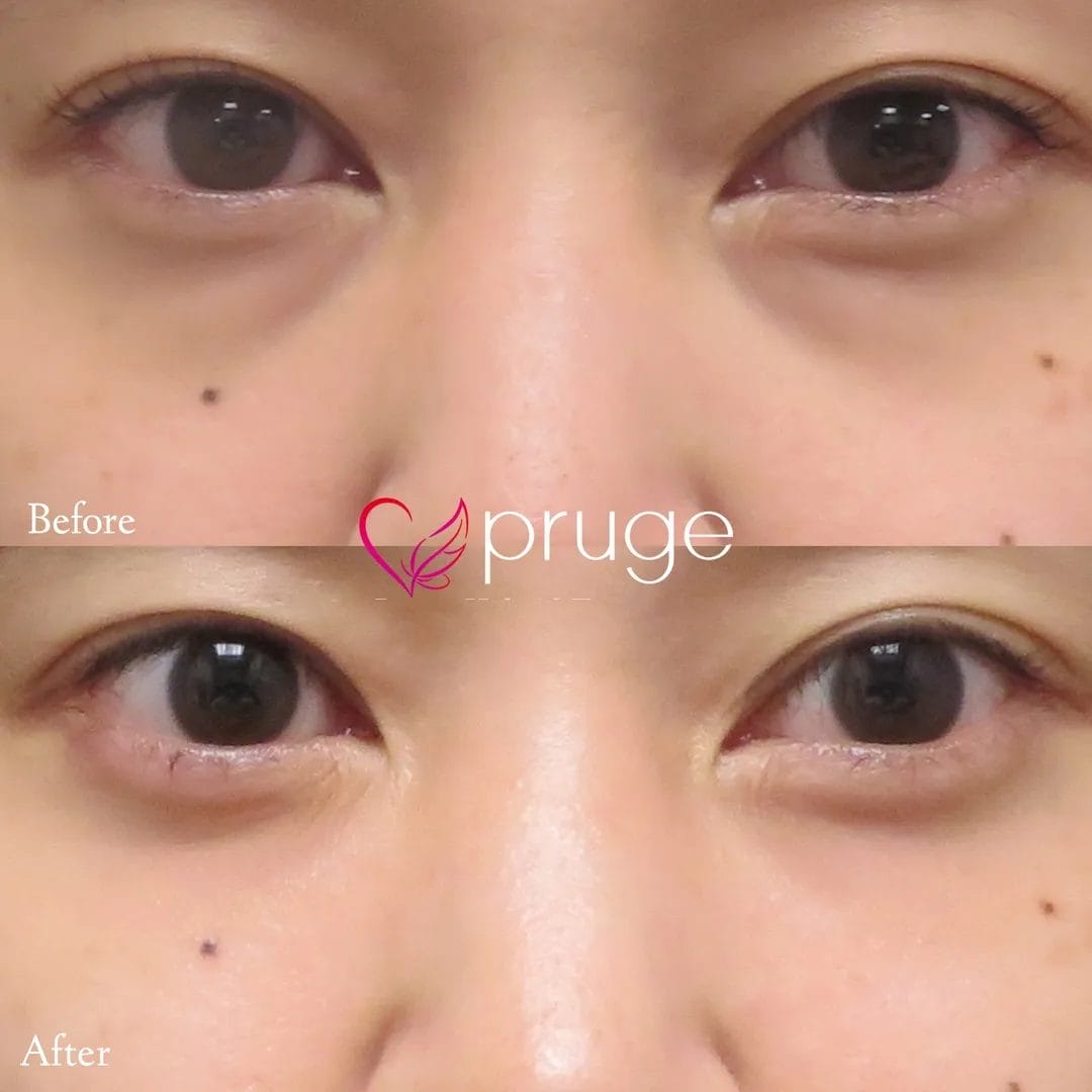 目の下のクマ・膨らみ