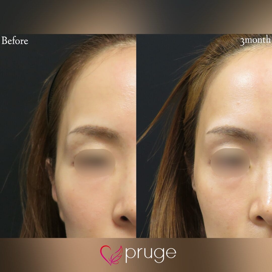 PRP注射(こめかみ凹み)