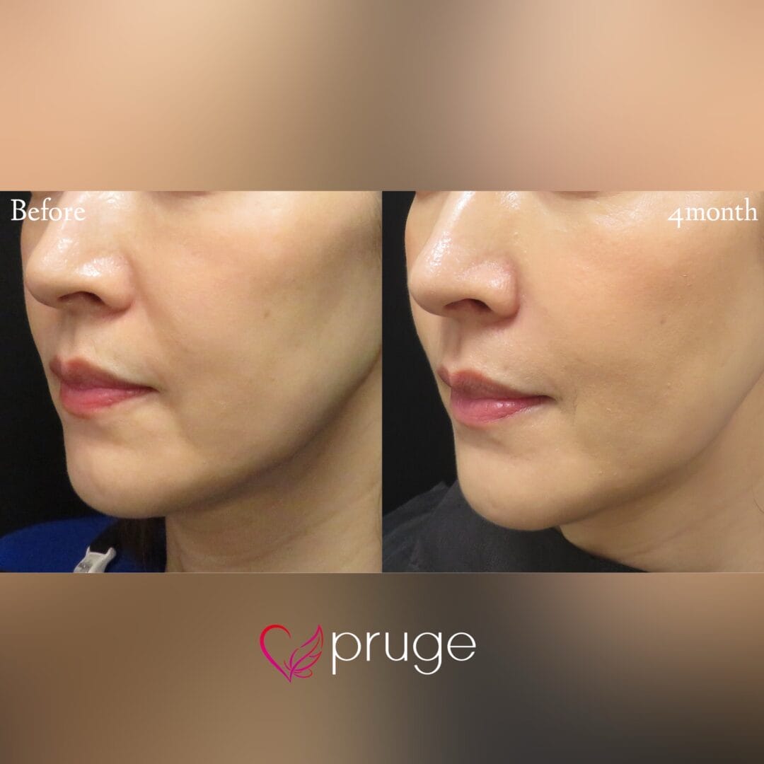 PRP注射 （法令線・マリオネットライン）