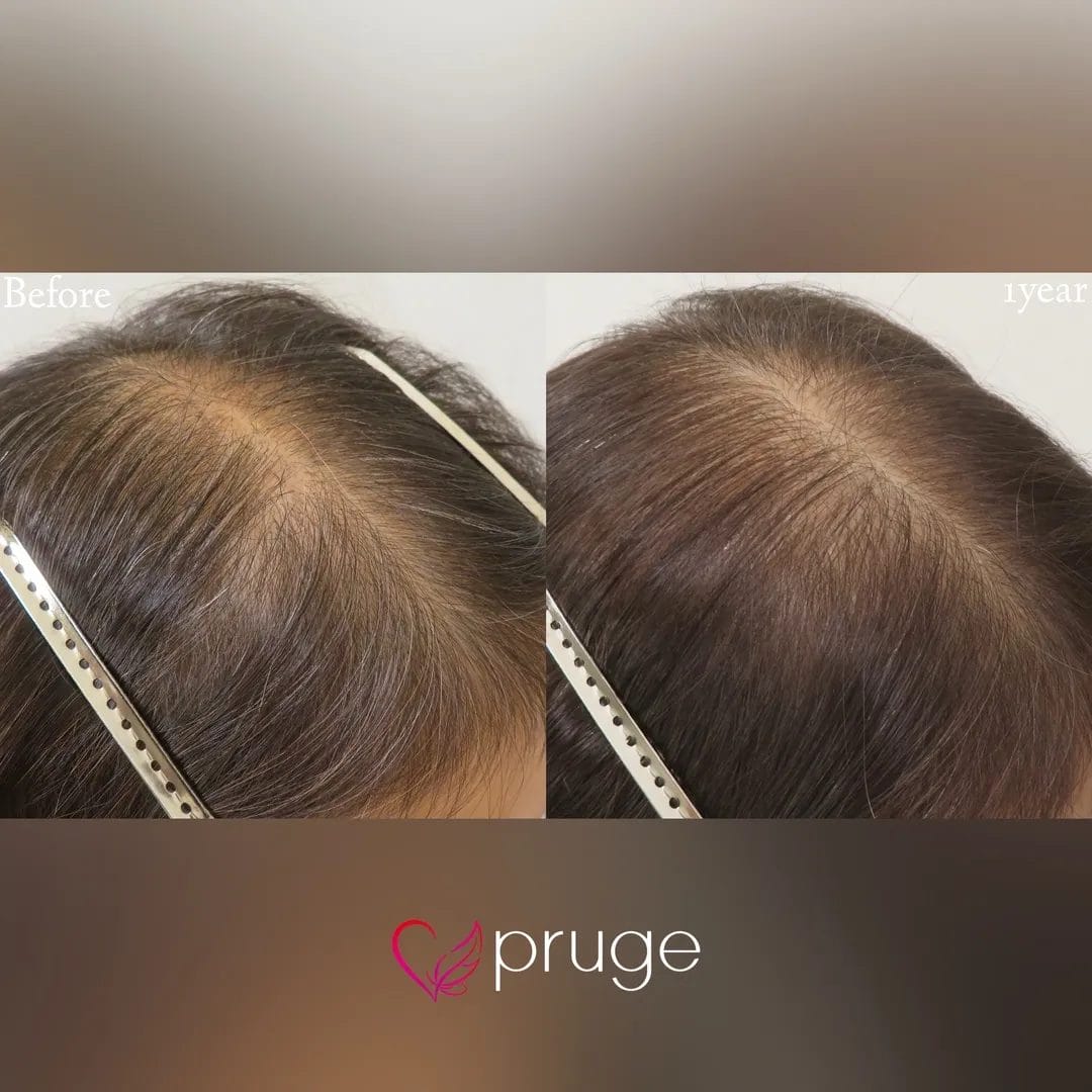 p-Scalp