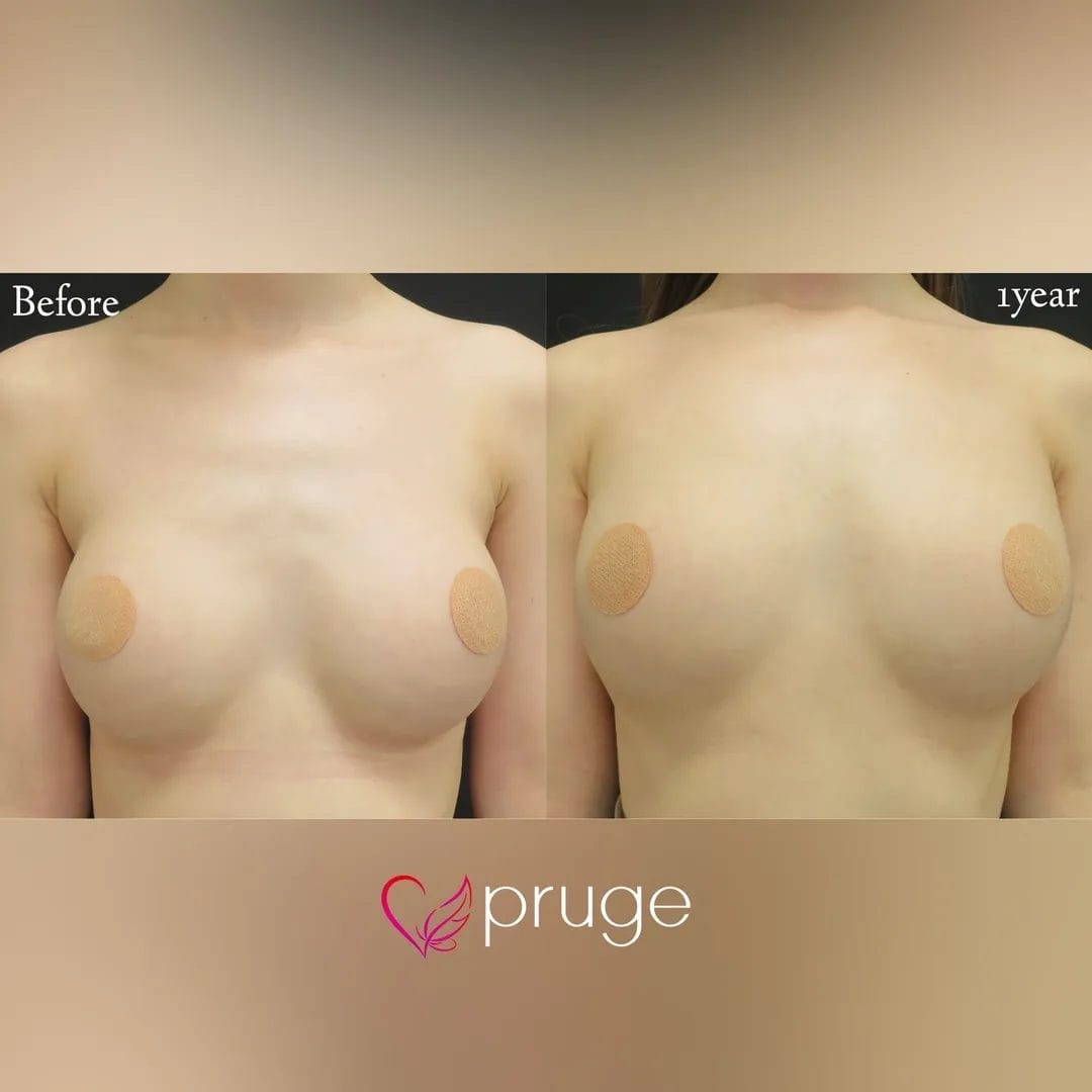 シリコンバッグ豊胸修正