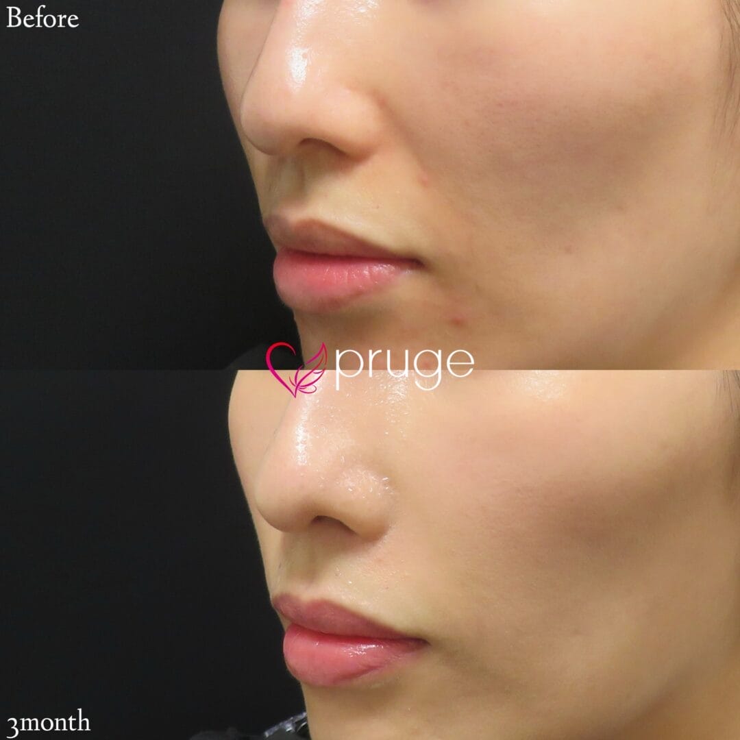 PRP注射（法令線）