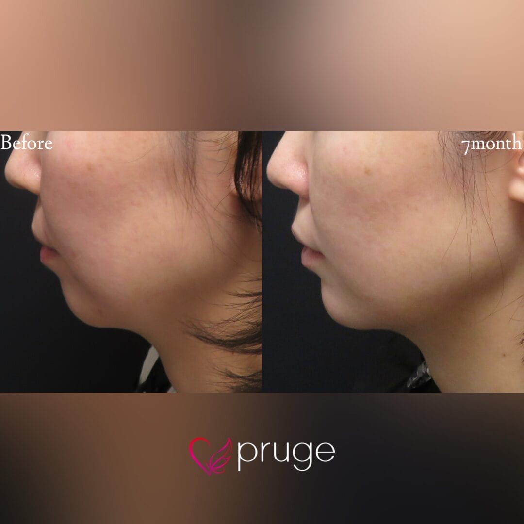 pスリム注射（フェイスライン・顎下）