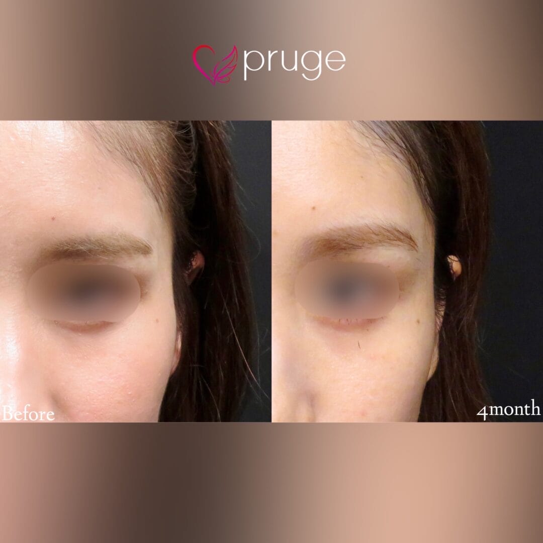 【PRP注射（こめかみ凹み)】