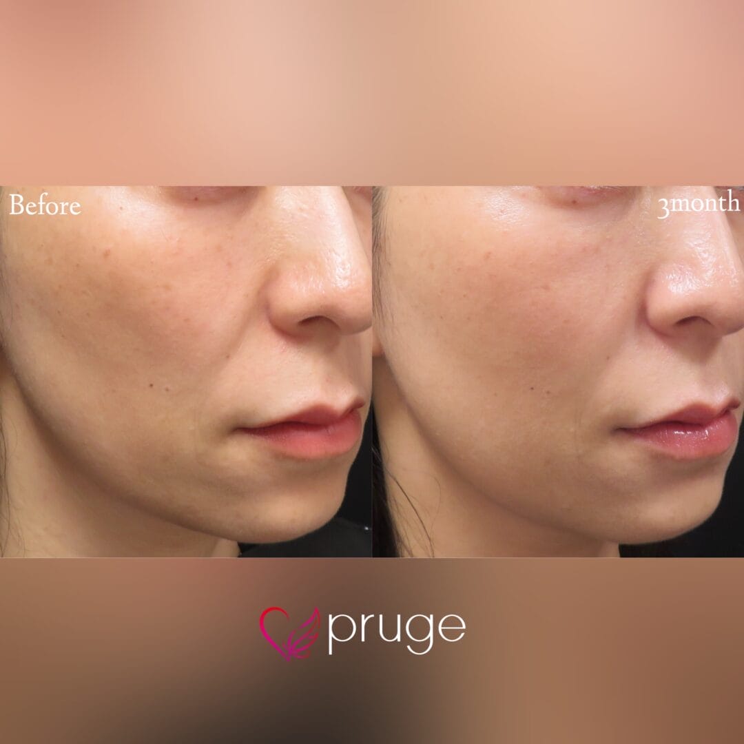 【PRP注射(ホホ)】