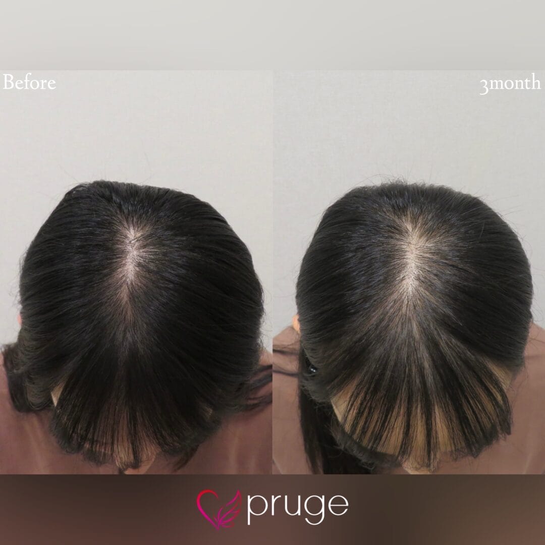 【PRP注射(後頭部形成術)】