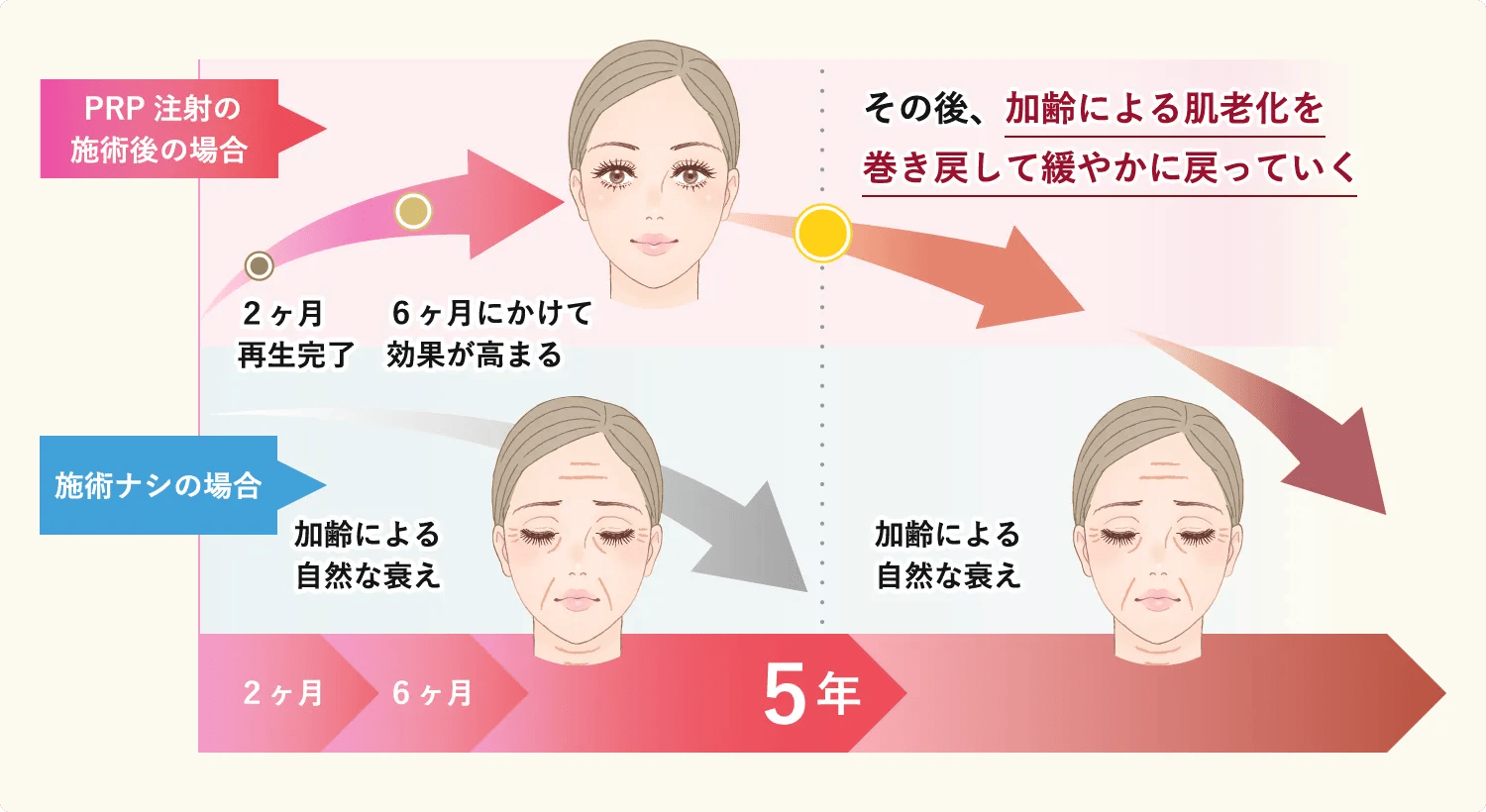 PRP注射の施術後の場合　2か月再生完了　6ヶ月にかけて効果が高まる　その後、加齢による肌老化を巻き戻して緩やかに戻っていく　施術ナシの場合　加齢による自然な衰え　加齢による自然な衰え　2か月　6ヶ月　5年