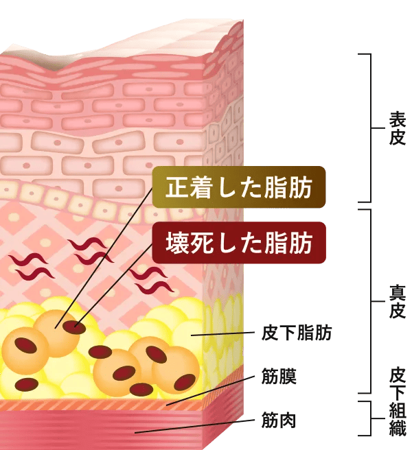表皮 真皮 皮下組織 正着した脂肪 壊死した脂肪 皮下脂肪 筋膜 筋肉