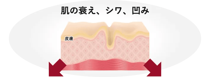 肌の衰え、シワ、凹み 皮膚