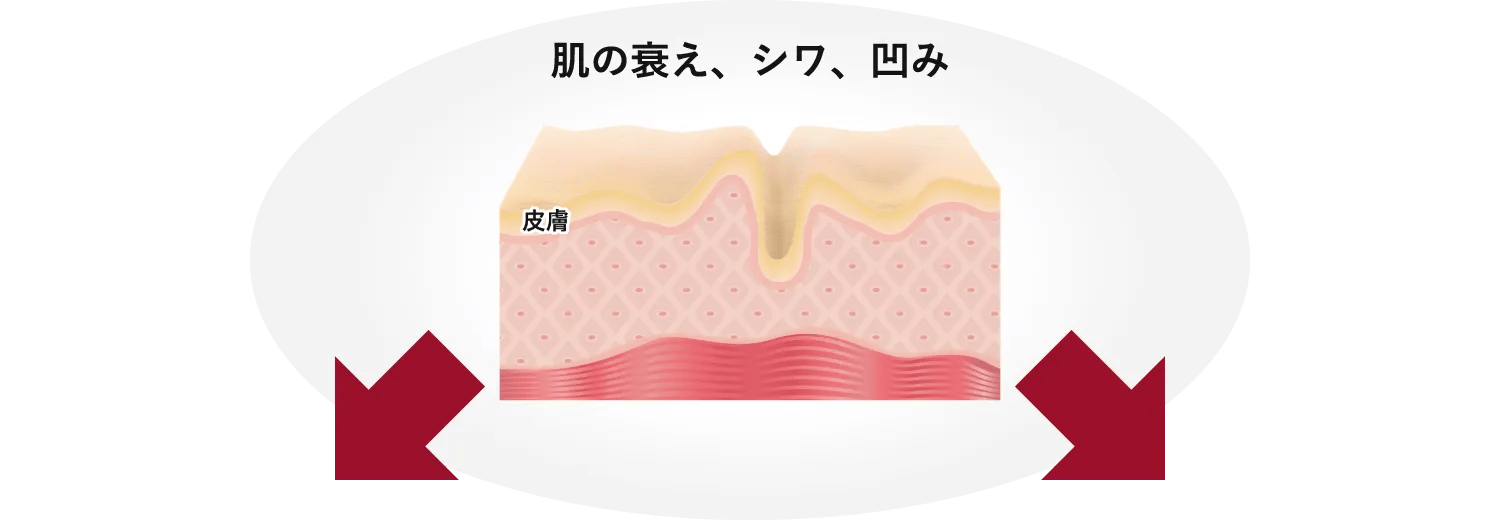 肌の衰え、シワ、凹み 皮膚