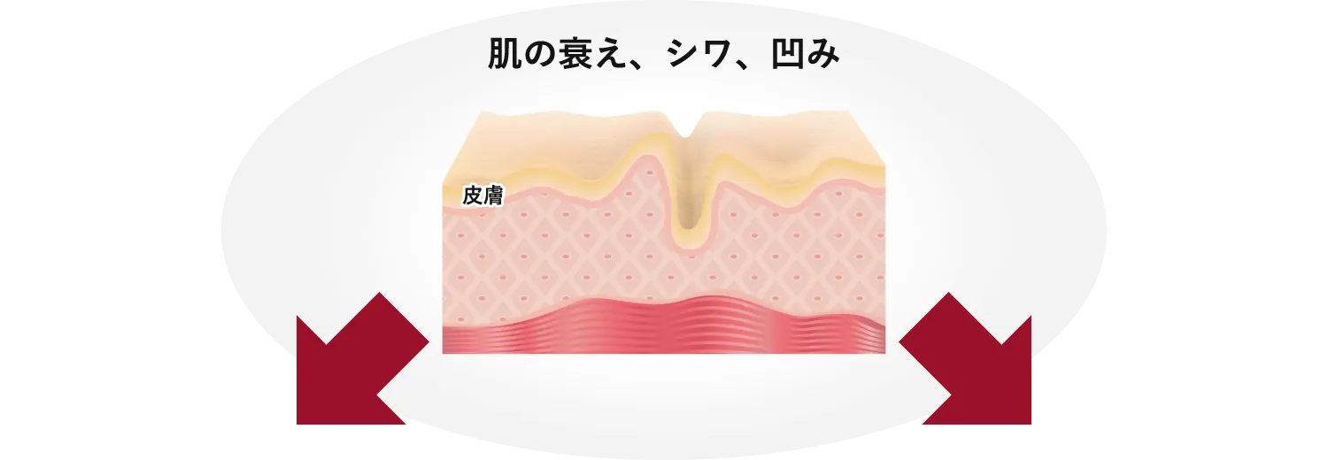 肌の衰え、シワ、凹み 皮膚