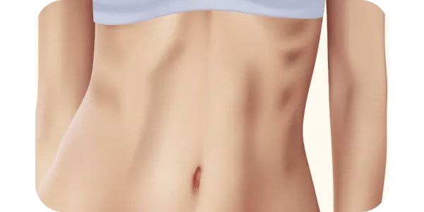 やせ型の方は脂肪が取れないことも