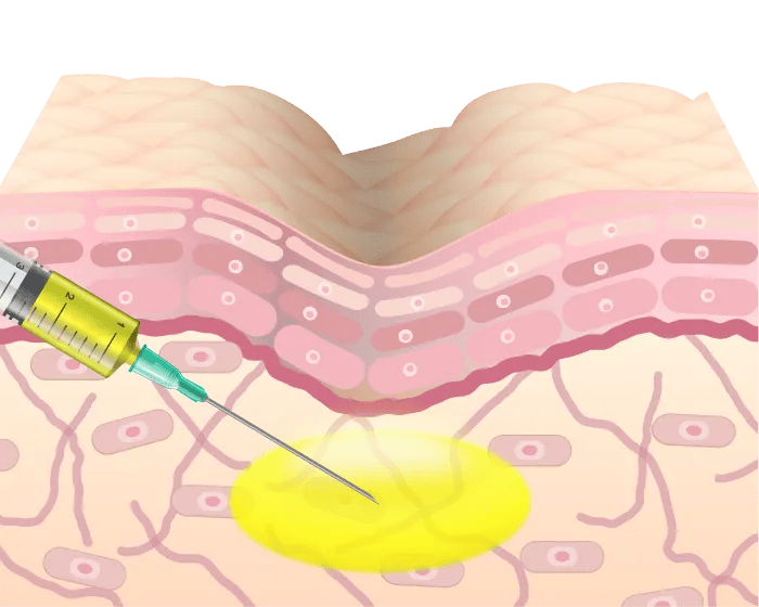 シワのある肌構造