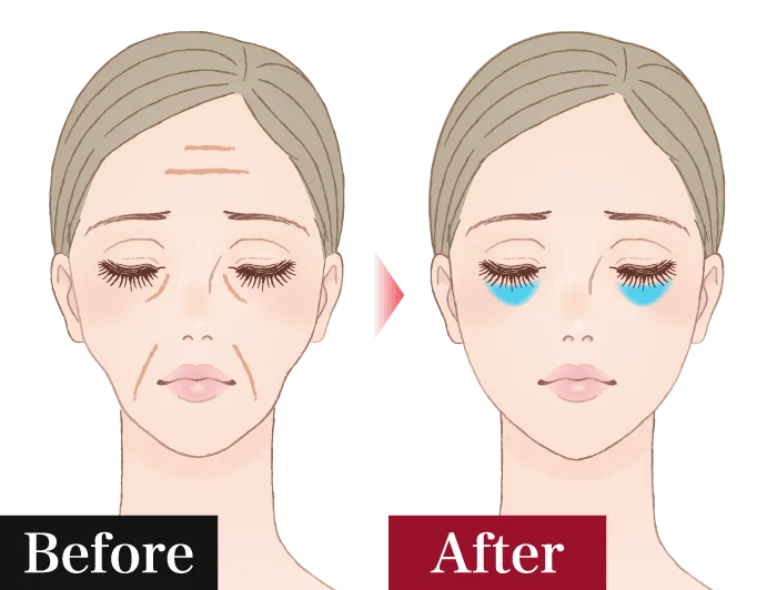 ヒアルロン酸注射