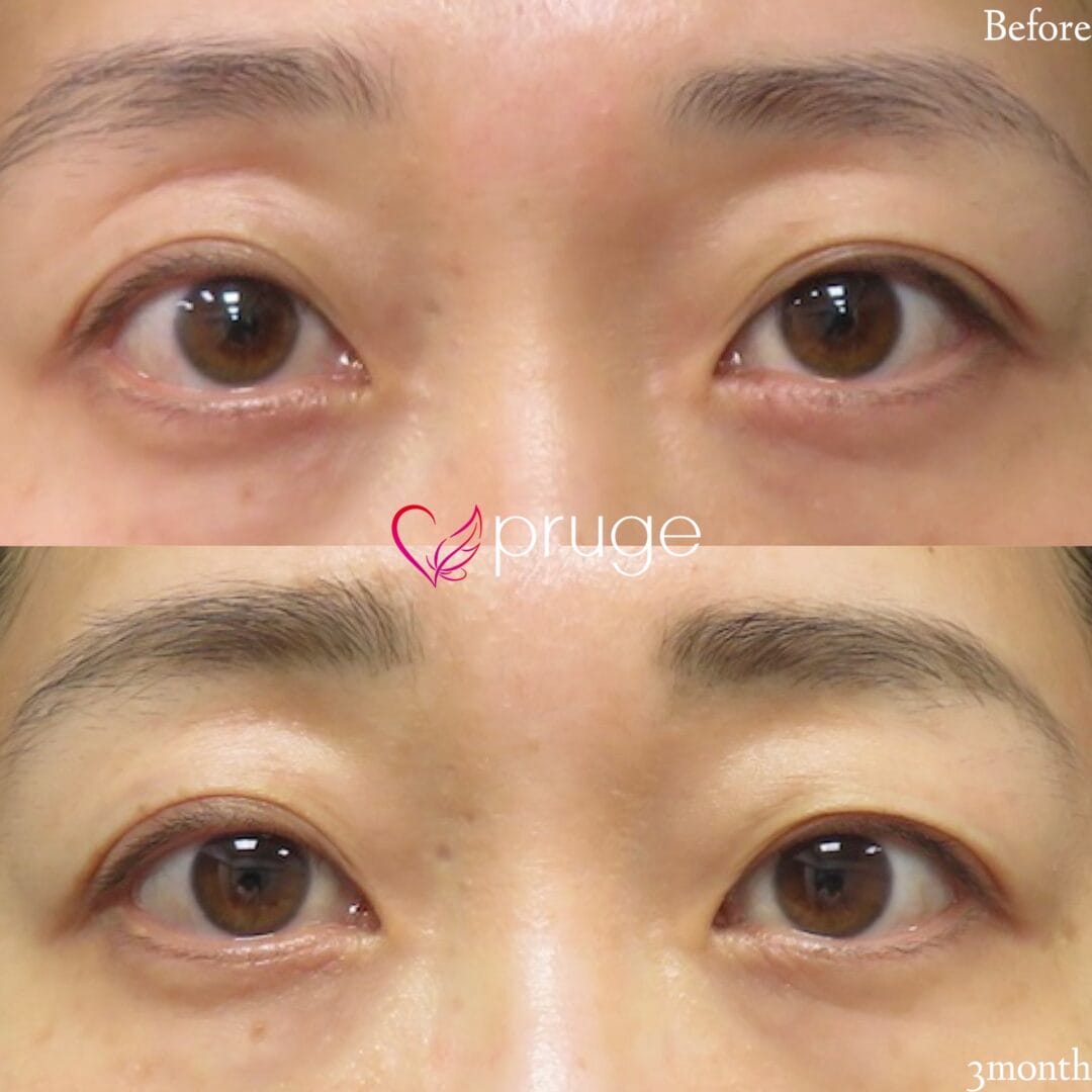 【PRP注射：目の上】