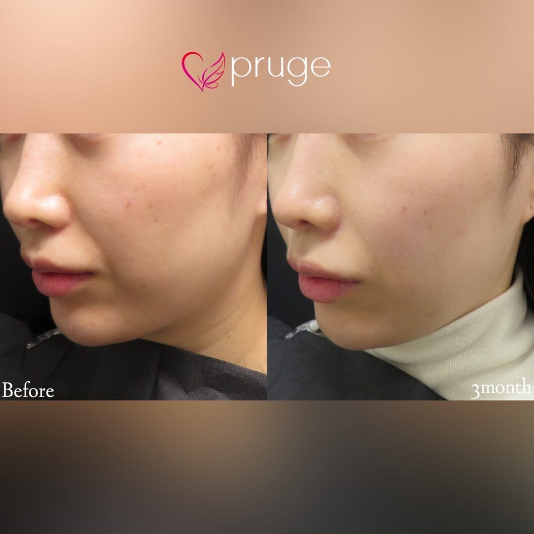 PRP注射(ホホ・ほうれい線)・ｐスリム注射(ほうれい線)