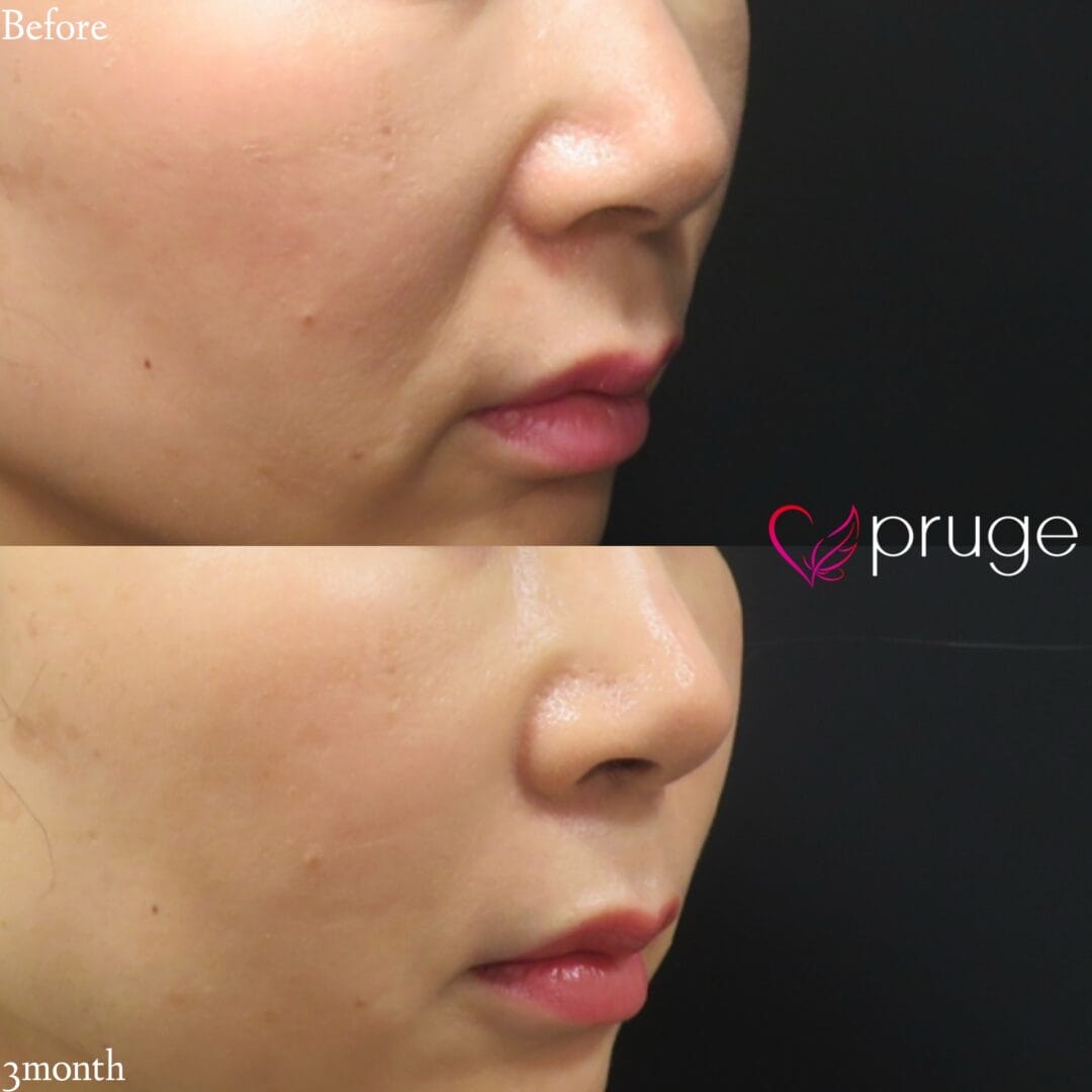 PRP注射(法令線)