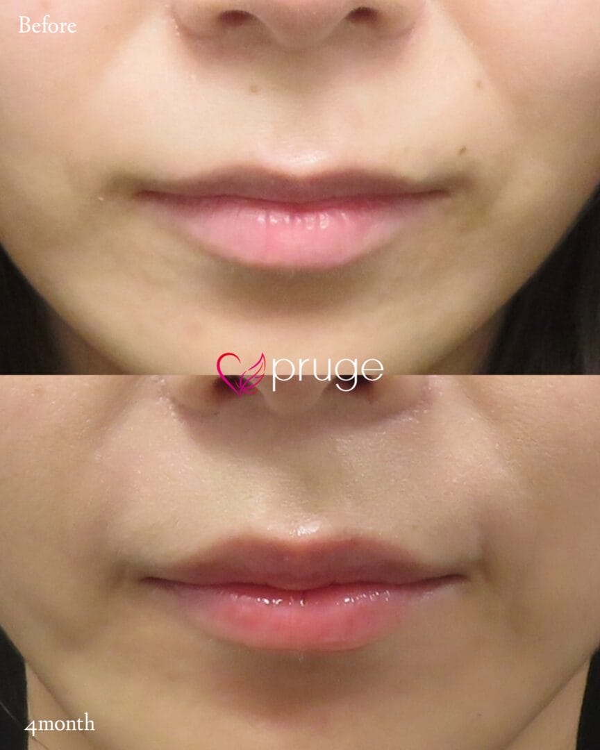 PRP注射（唇）