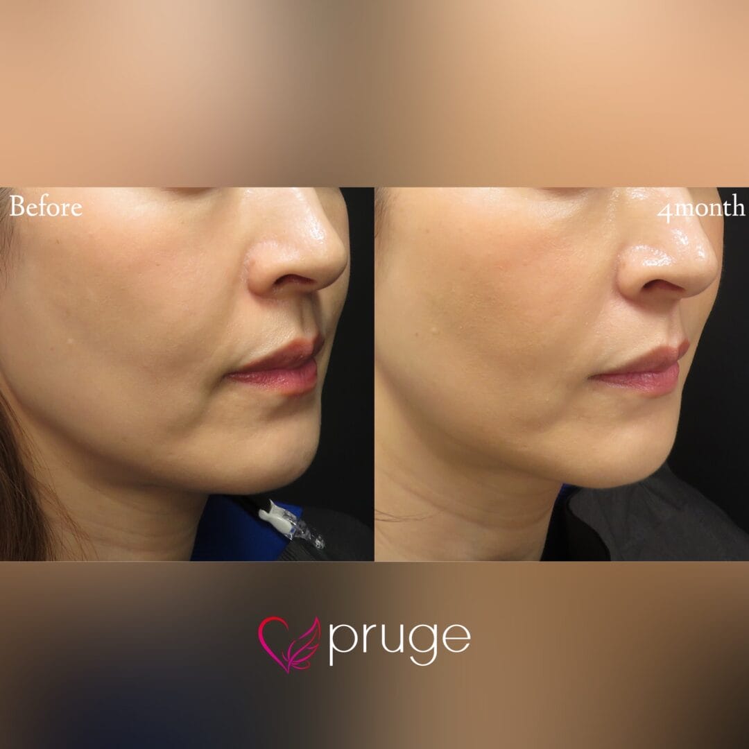 PRP注射（法令線・マリオネットライン）