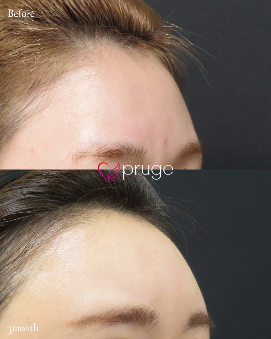 PRP注射（ひたい・こめかみ丸み形成）