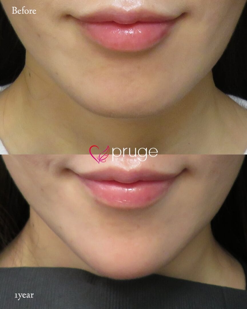 PRP注射（あご）